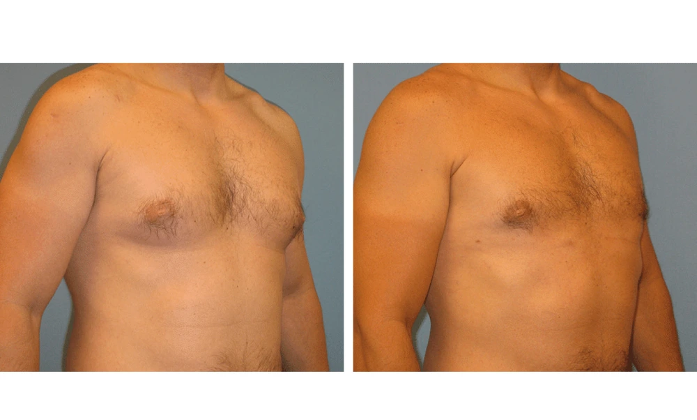 Gynecomastia - Case 2 (1)