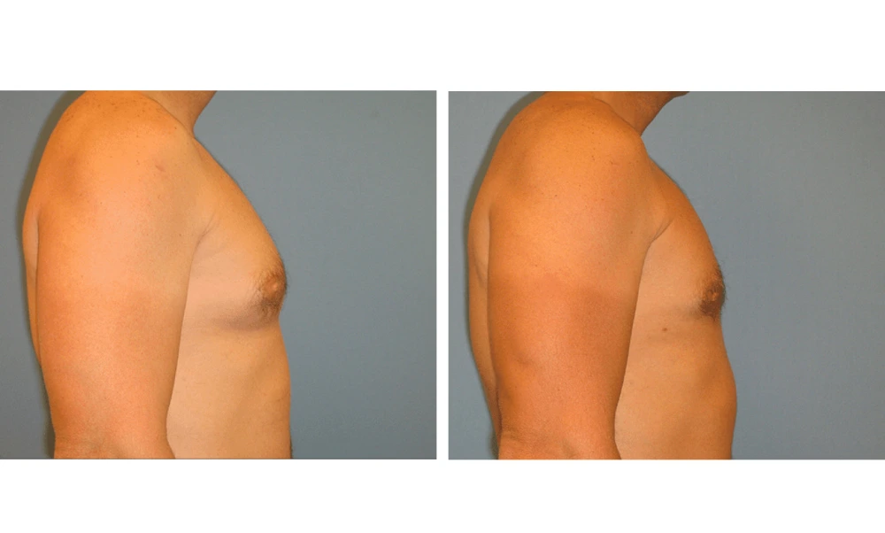 Gynecomastia - Case 2 (2)