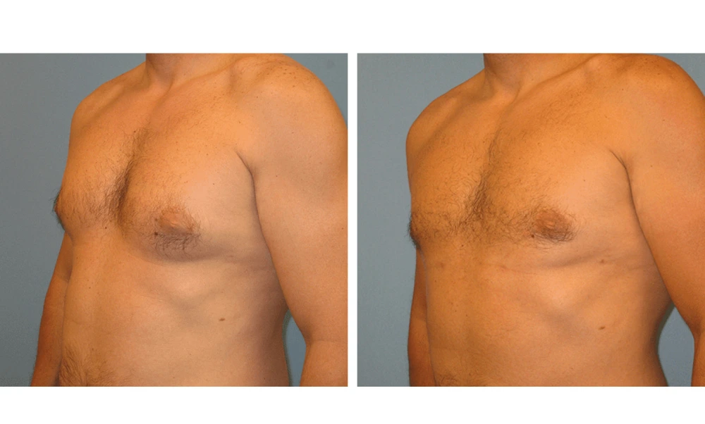Gynecomastia - Case 2 (3)