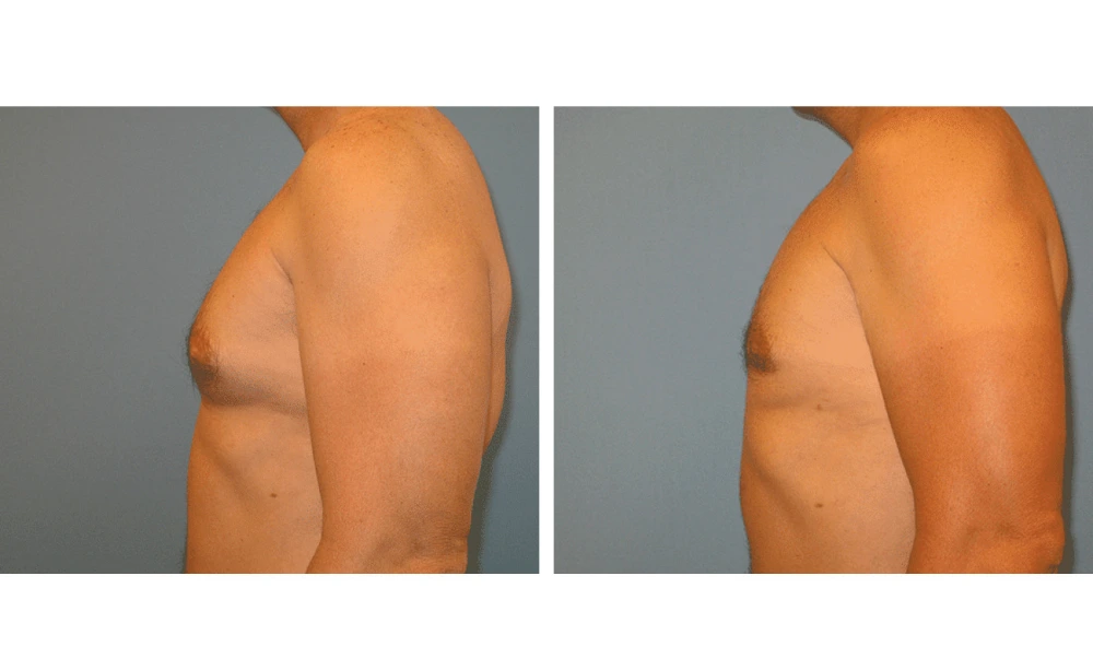 Gynecomastia - Case 2 (4)
