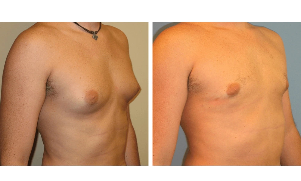 Gynecomastia - Case 3 (1)