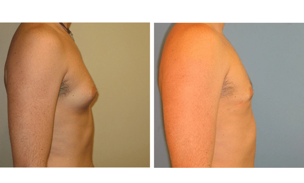 Gynecomastia - Case 3 (2)