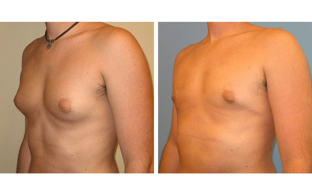 Gynecomastia - Case 3 (3)