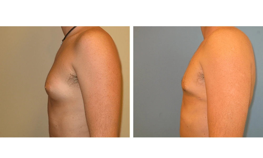 Gynecomastia - Case 3 (4)