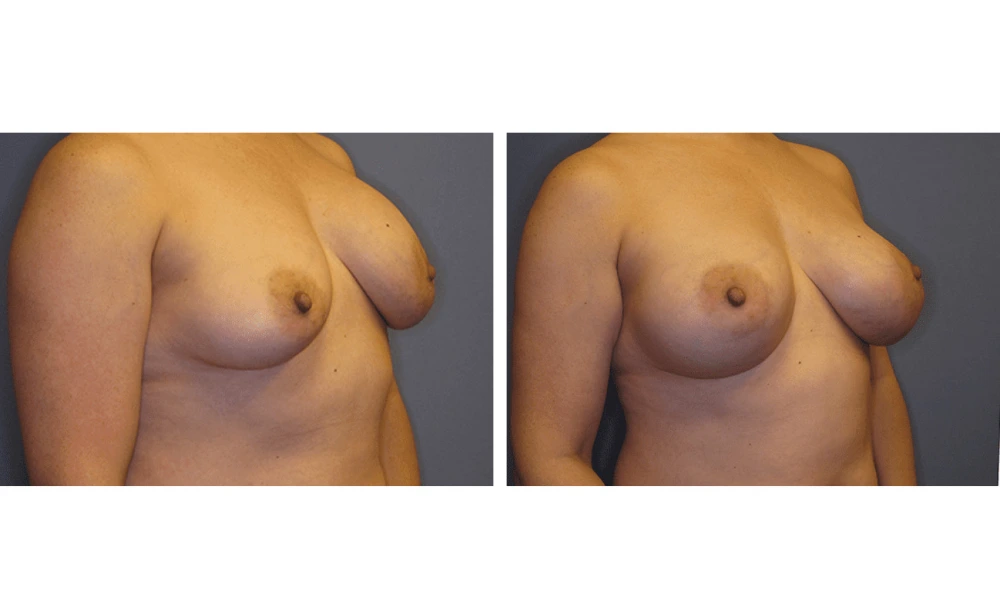 Implant Exchange - Case 1 (1)