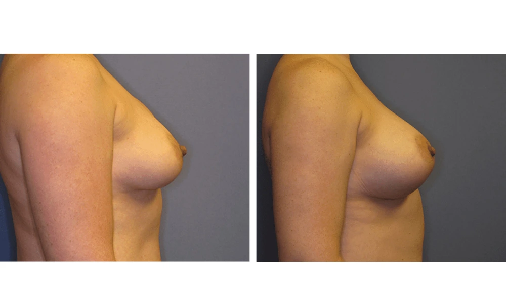 Implant Exchange - Case 1 (2)