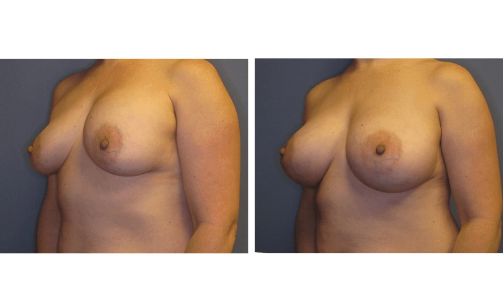 Implant Exchange - Case 1 (3)