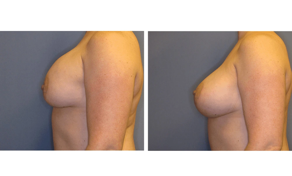 Implant Exchange - Case 1 (4)