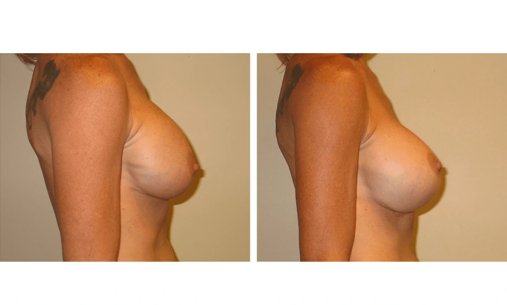 Implant Exchange - Case 1 (7)