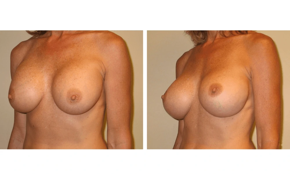 Implant Exchange - Case 1 (8)