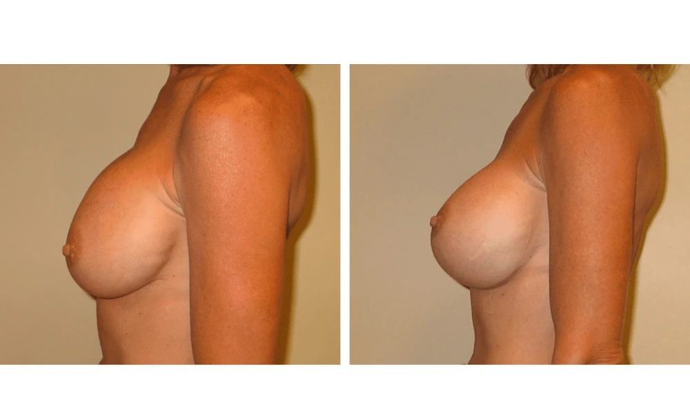 Implant Exchange - Case 1 (9)