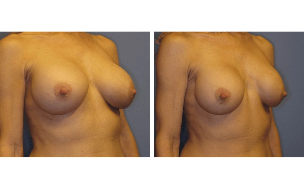 Implant Exchange - Case 3 (1)