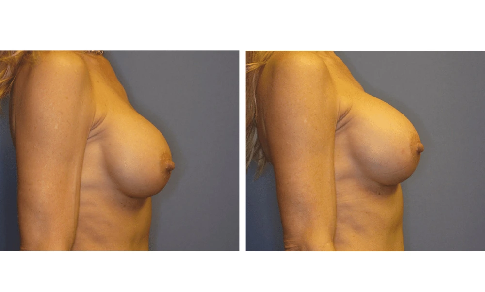 Implant Exchange - Case 3 (2)