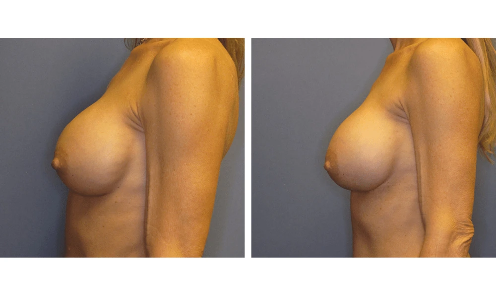 Implant Exchange - Case 3 (4)