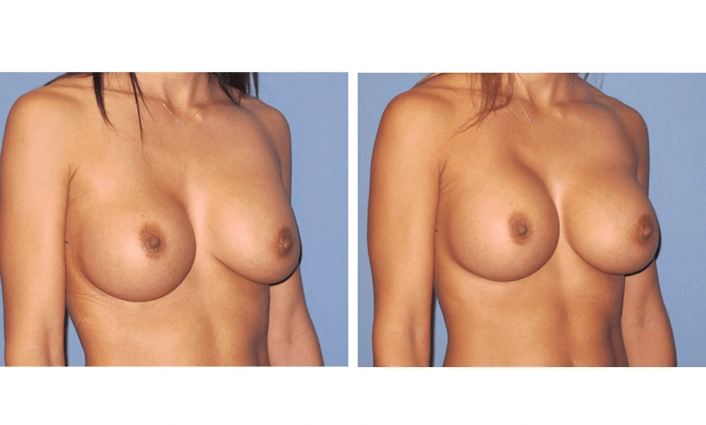 Implant Exchange - Case 4 (1)