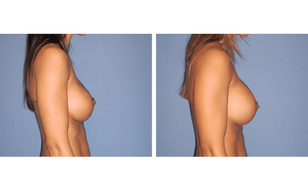 Implant Exchange - Case 4 (2)