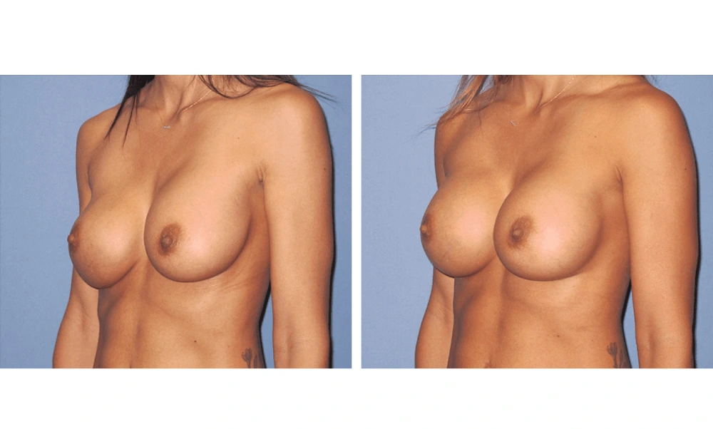 Implant Exchange - Case 4 (3)