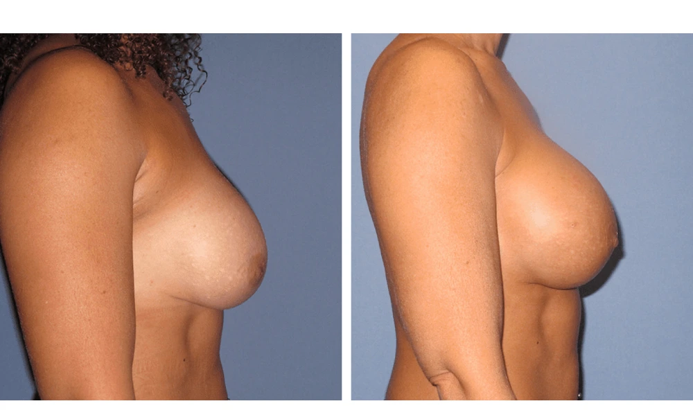 Implant Exchange - Case 5 (2)