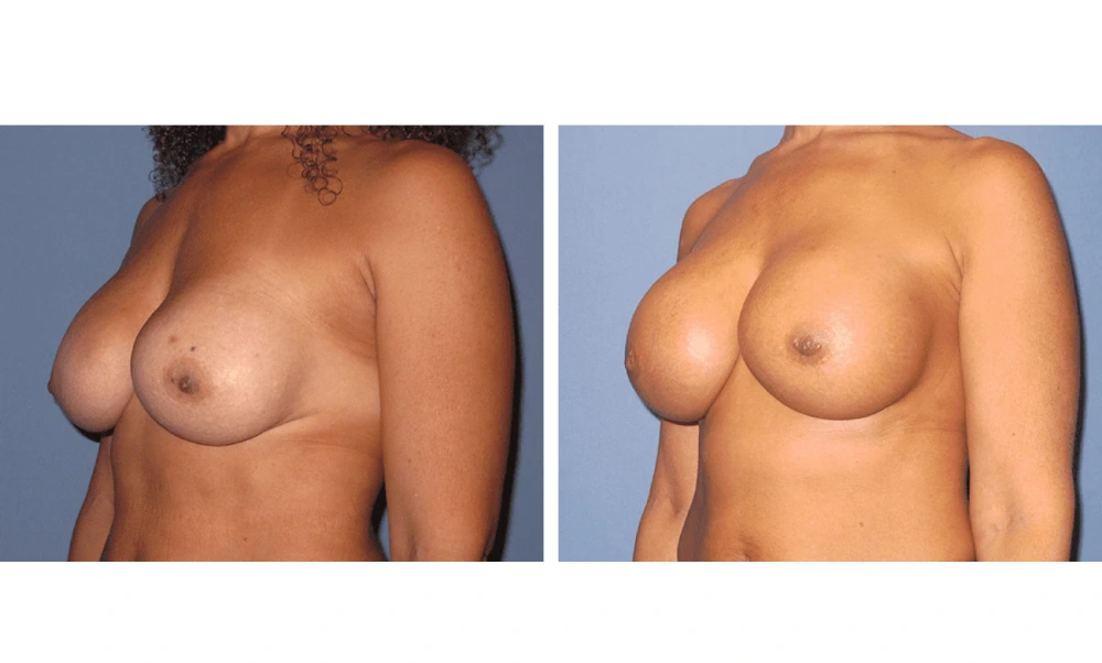 Implant Exchange - Case 5 (3)