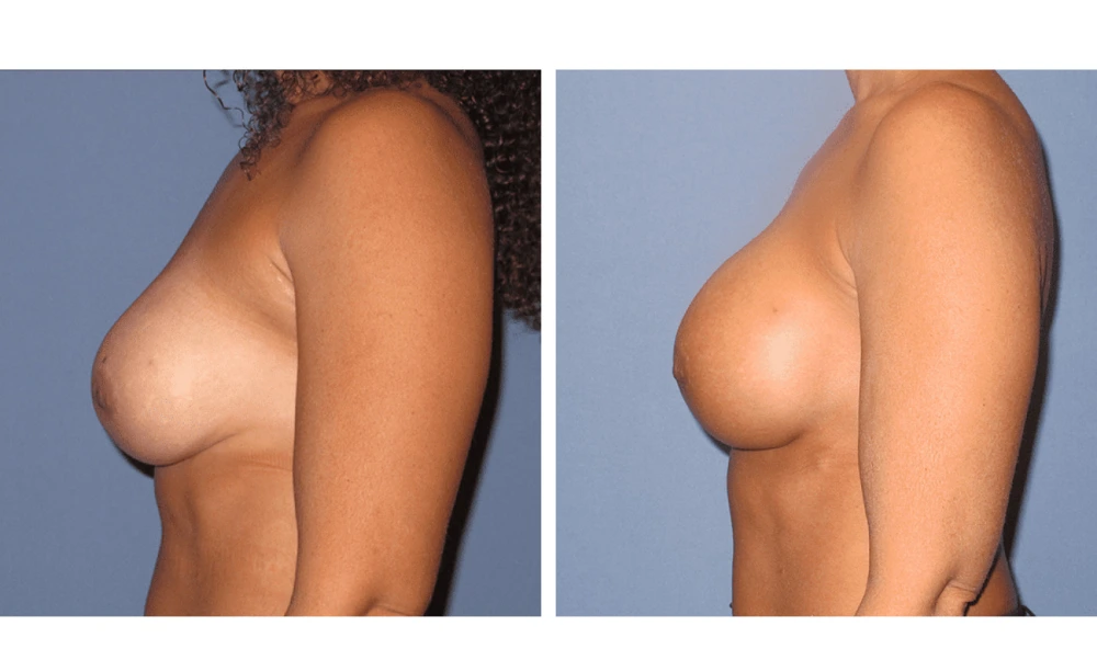 Implant Exchange - Case 5 (5)