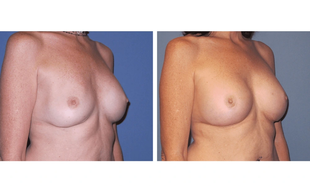 Implant Exchange - Case 6 (1)