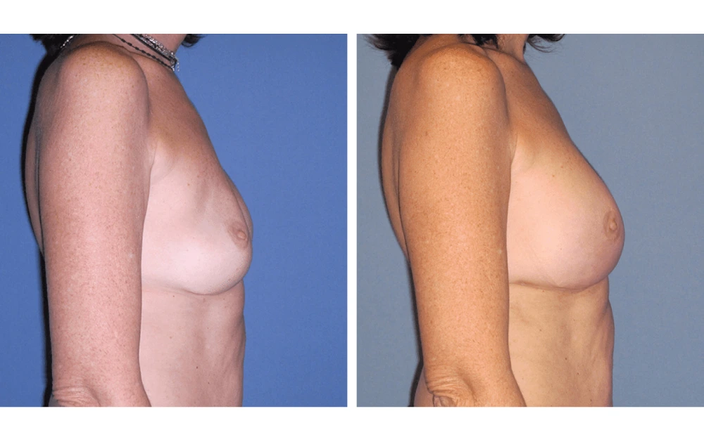 Implant Exchange - Case 6 (2)