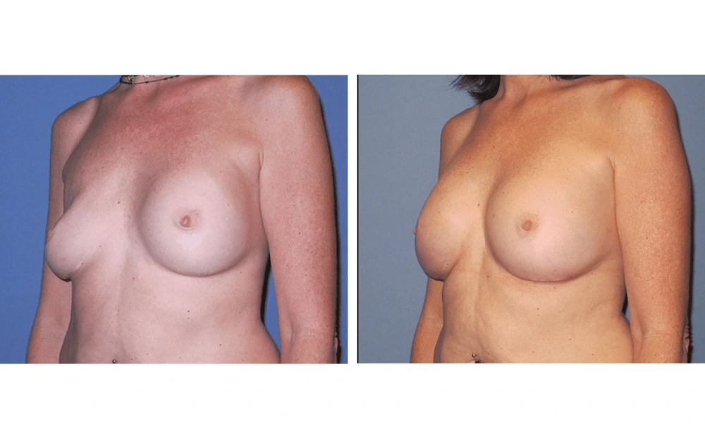 Implant Exchange - Case 6 (3)