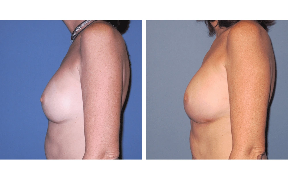 Implant Exchange - Case 6 (4)