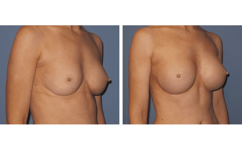 Implant Exchange - Case 7 (3)