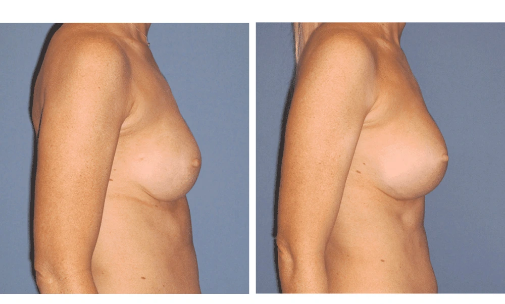 Implant Exchange - Case 7 (4)