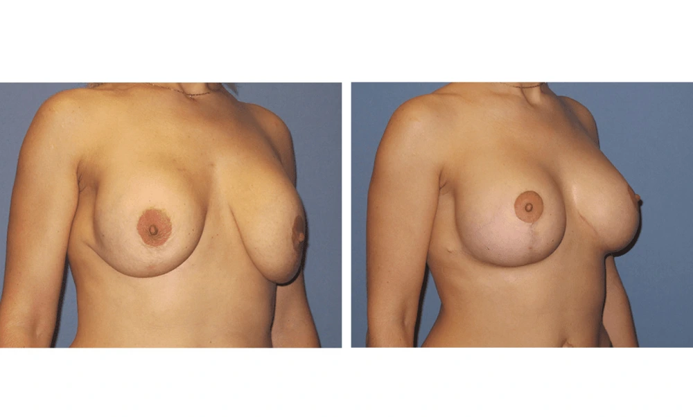 Implant Exchange - Case 8 (1)