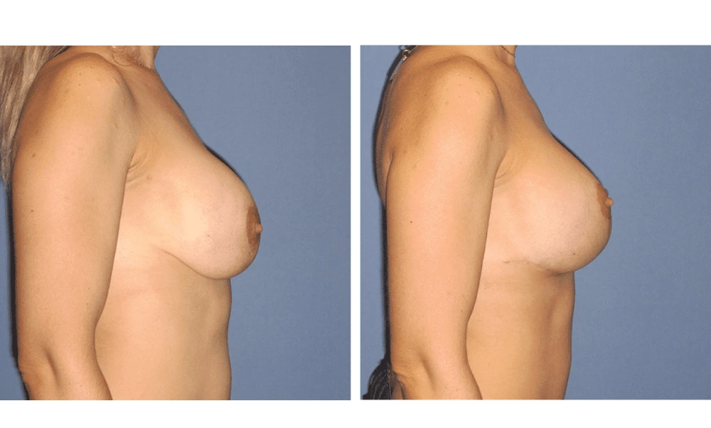 Implant Exchange - Case 8 (2)