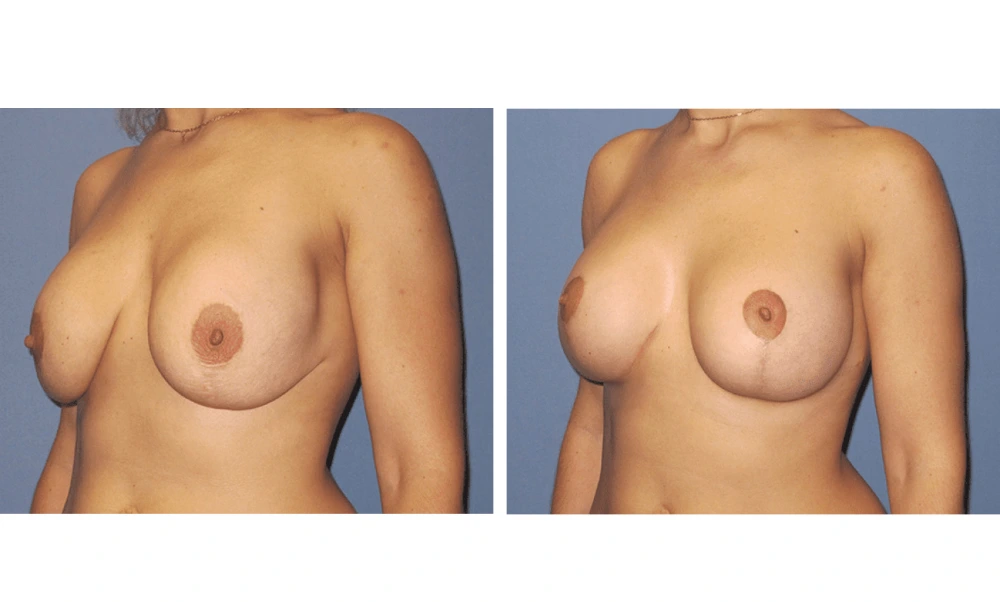 Implant Exchange - Case 8 (3)