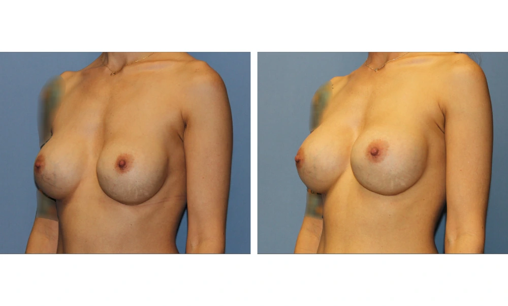 Implant Exchange - Case 9 (3)