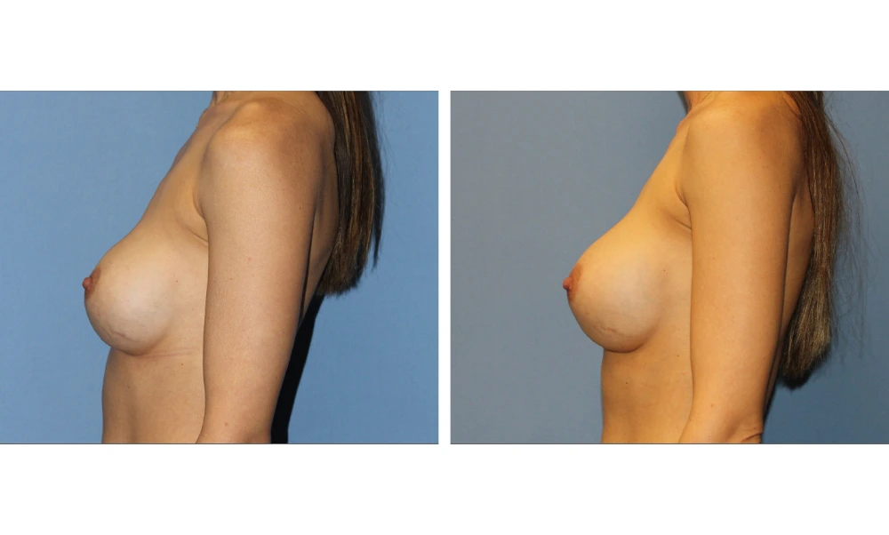 Implant Exchange - Case 9 (4)