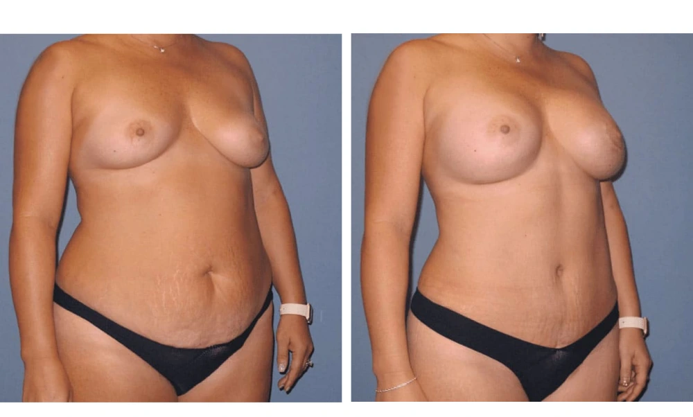 Mommy Makeover - Case 1 (1)