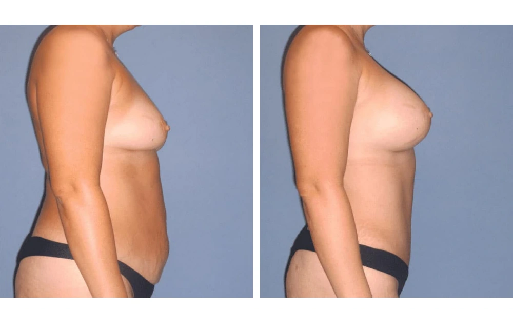 Mommy Makeover - Case 1 (2)