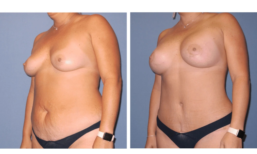 Mommy Makeover - Case 1 (3)