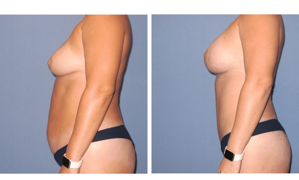 Mommy Makeover - Case 1 (4)