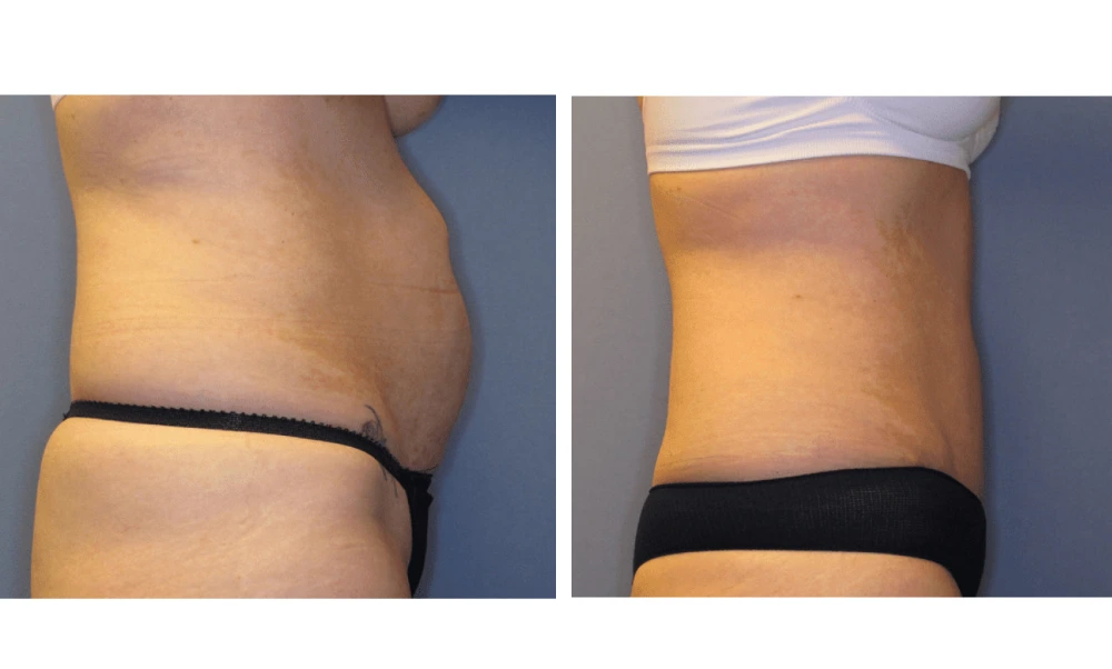 Tummy Tuck - Case 1 (2)