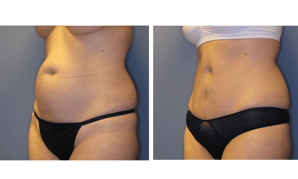 Tummy Tuck - Case 1 (3)