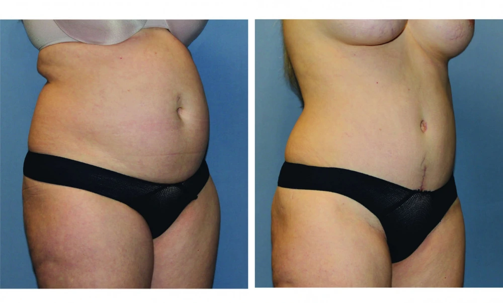 Tummy Tuck - Case 10 (1)