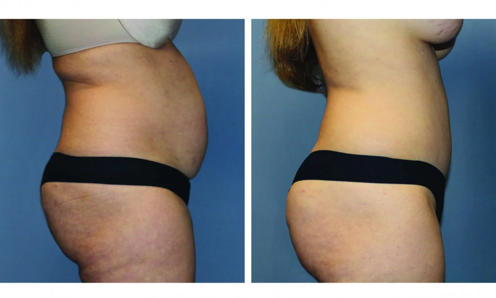Tummy Tuck - Case 10 (2)
