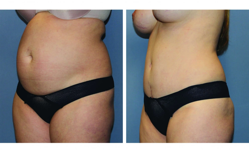 Tummy Tuck - Case 10 (3)