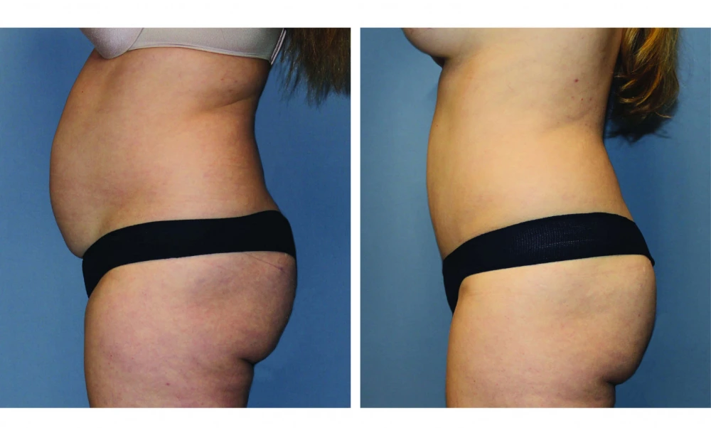 Tummy Tuck - Case 10 (4)