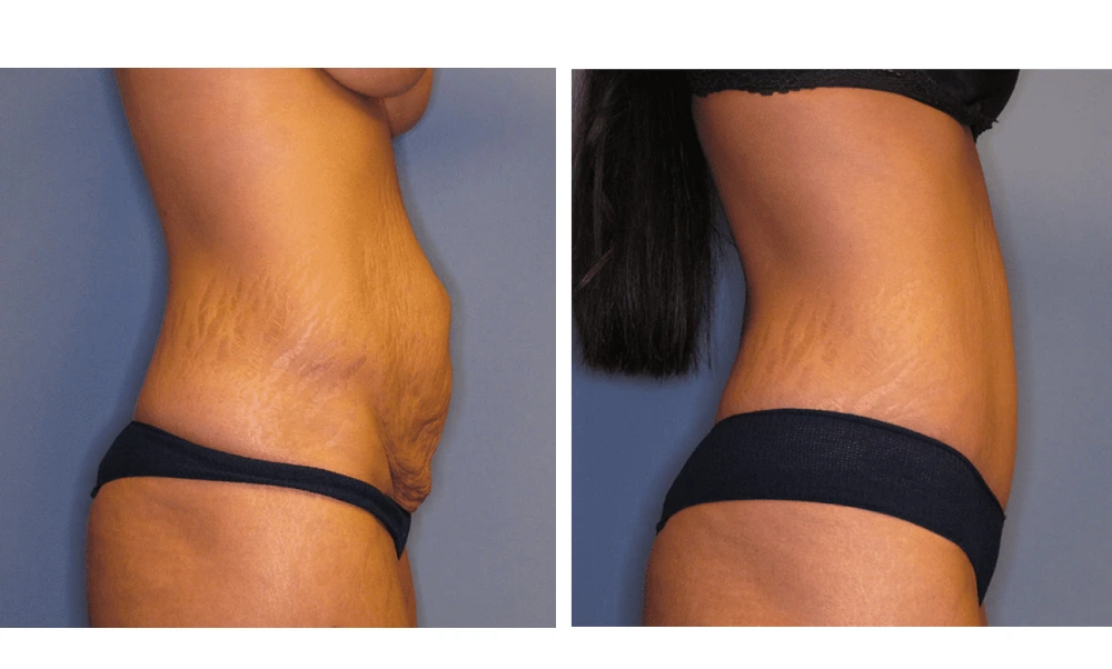 Tummy Tuck - Case 2 (2)