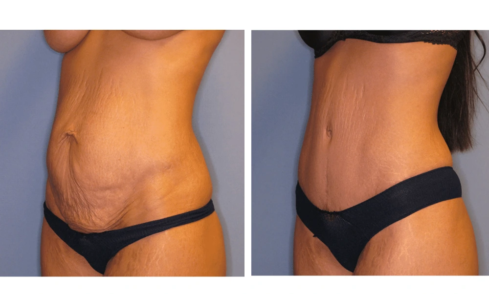 Tummy Tuck - Case 2 (3)