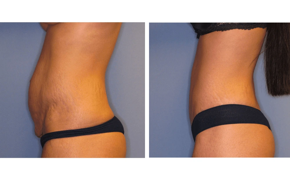 Tummy Tuck - Case 2 (4)