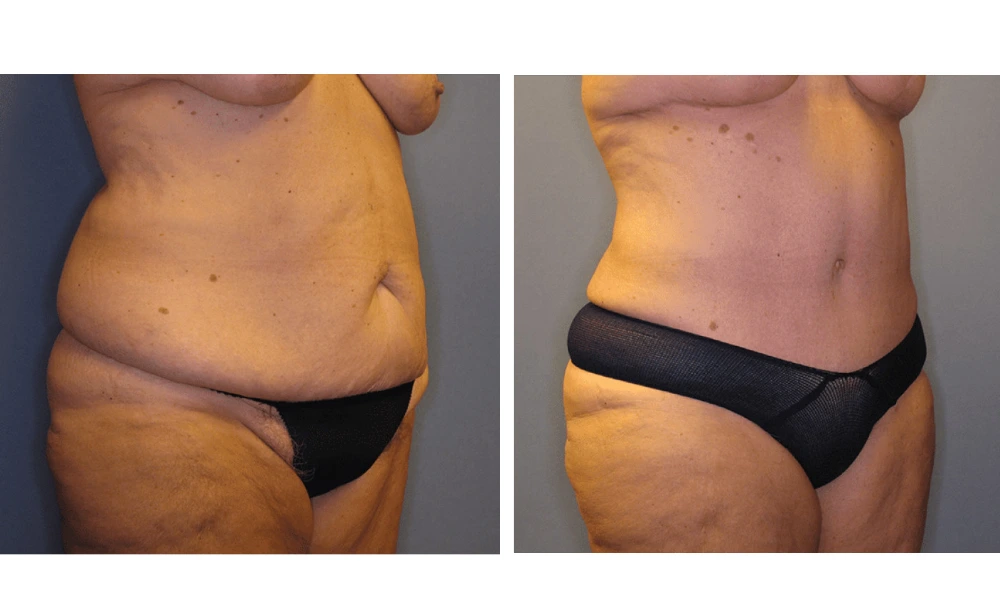 Tummy Tuck - Case 3 (1)
