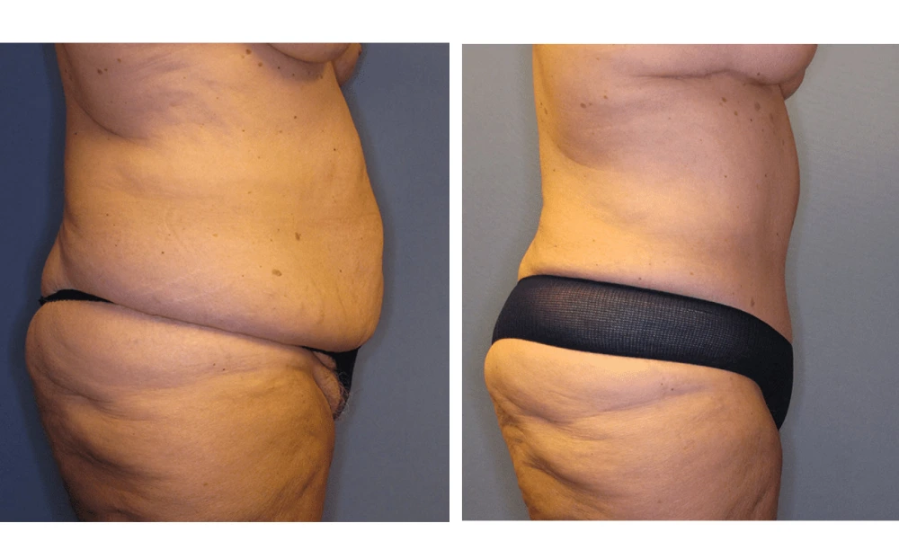 Tummy Tuck - Case 3 (2)